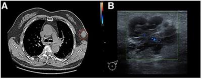 Triple-negative accessory breast cancer occurring concurrently with primary invasive breast carcinoma: a case report